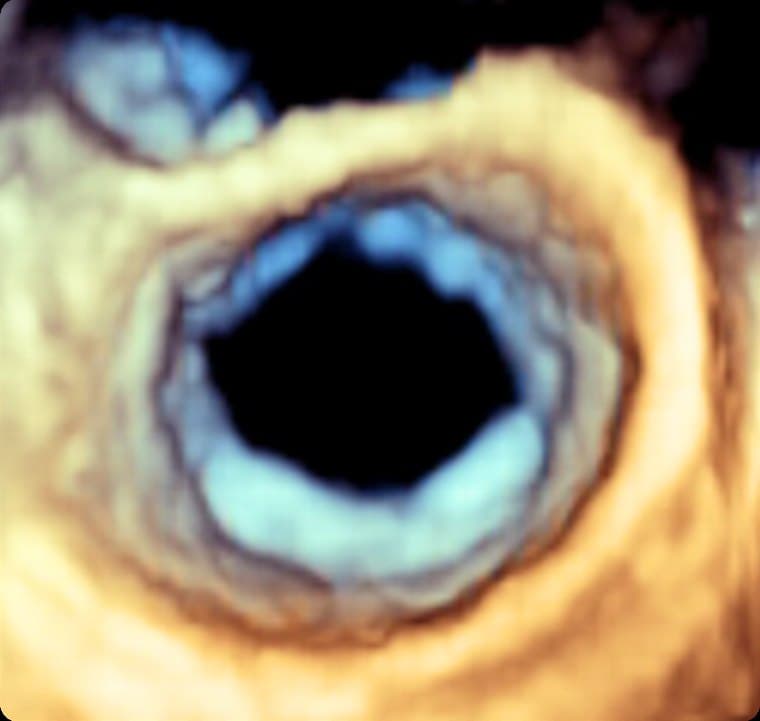 Échographie cardiaque 3D : vue de face d'une valve cardiaque ouverte.