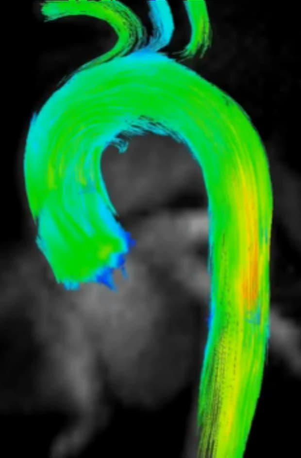 IRM cardiaque : cartographie en couleurs des flux sanguins dans l'aorte.