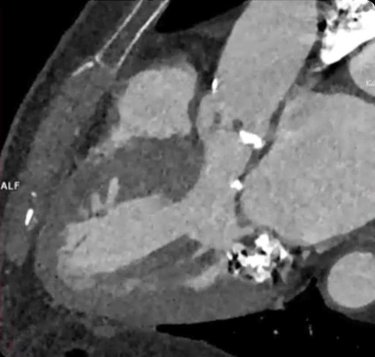 Scanner cardiaque : coupe longitudinale du cœur et de la valve aortique calcifiée.