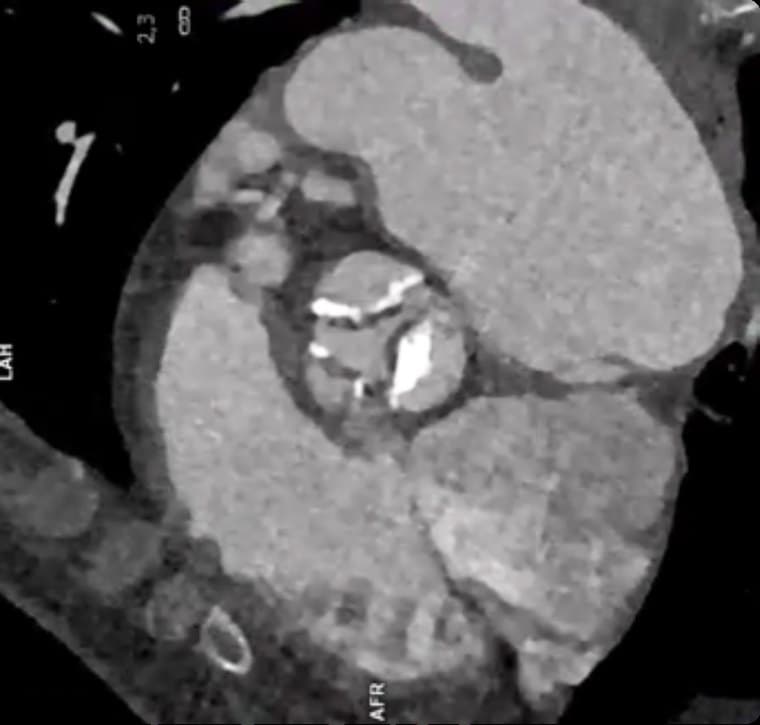 Scanner cardiaque : coupe transversale centrée sur la valve aortique.